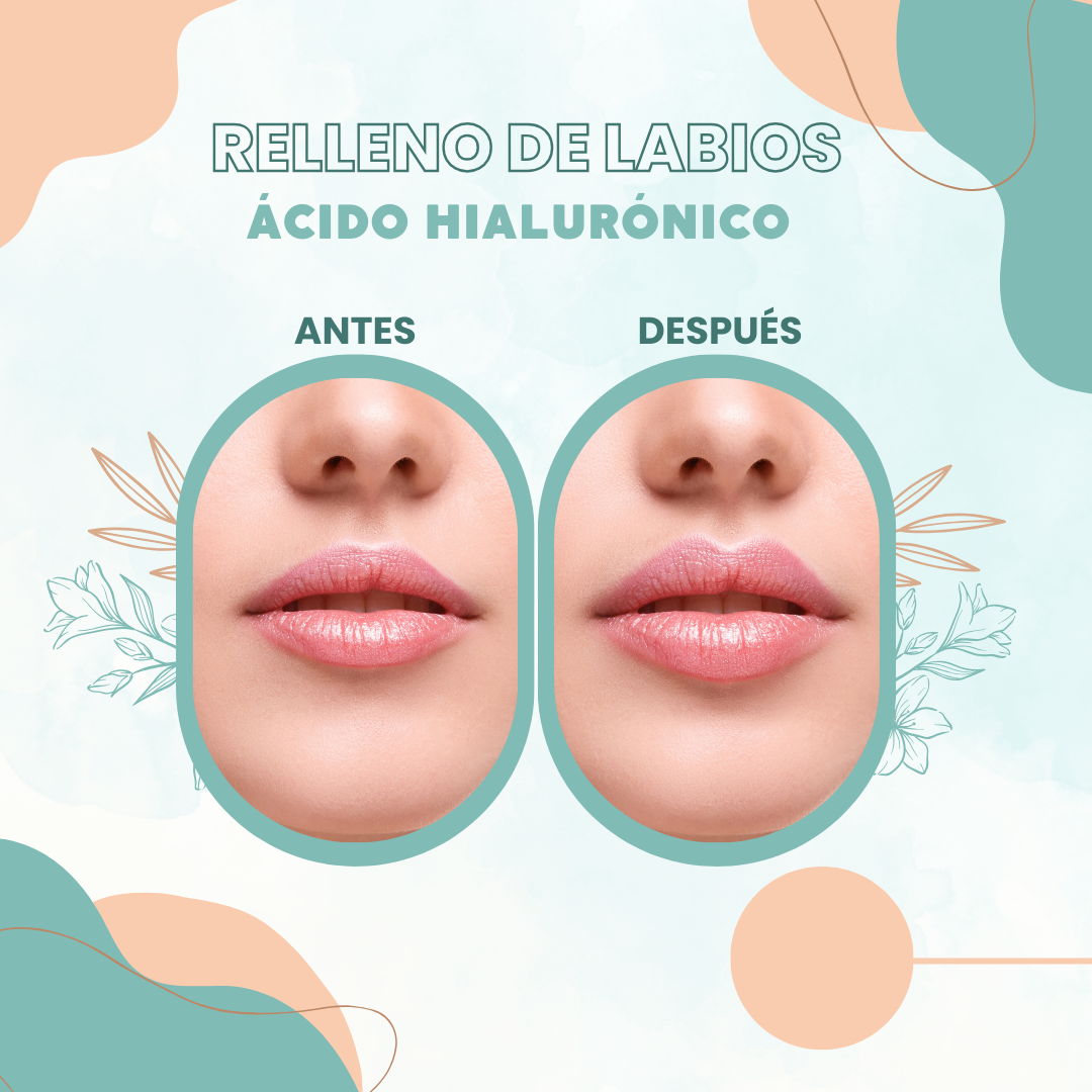 RELLENO DE LABIOS clinica dental durcal