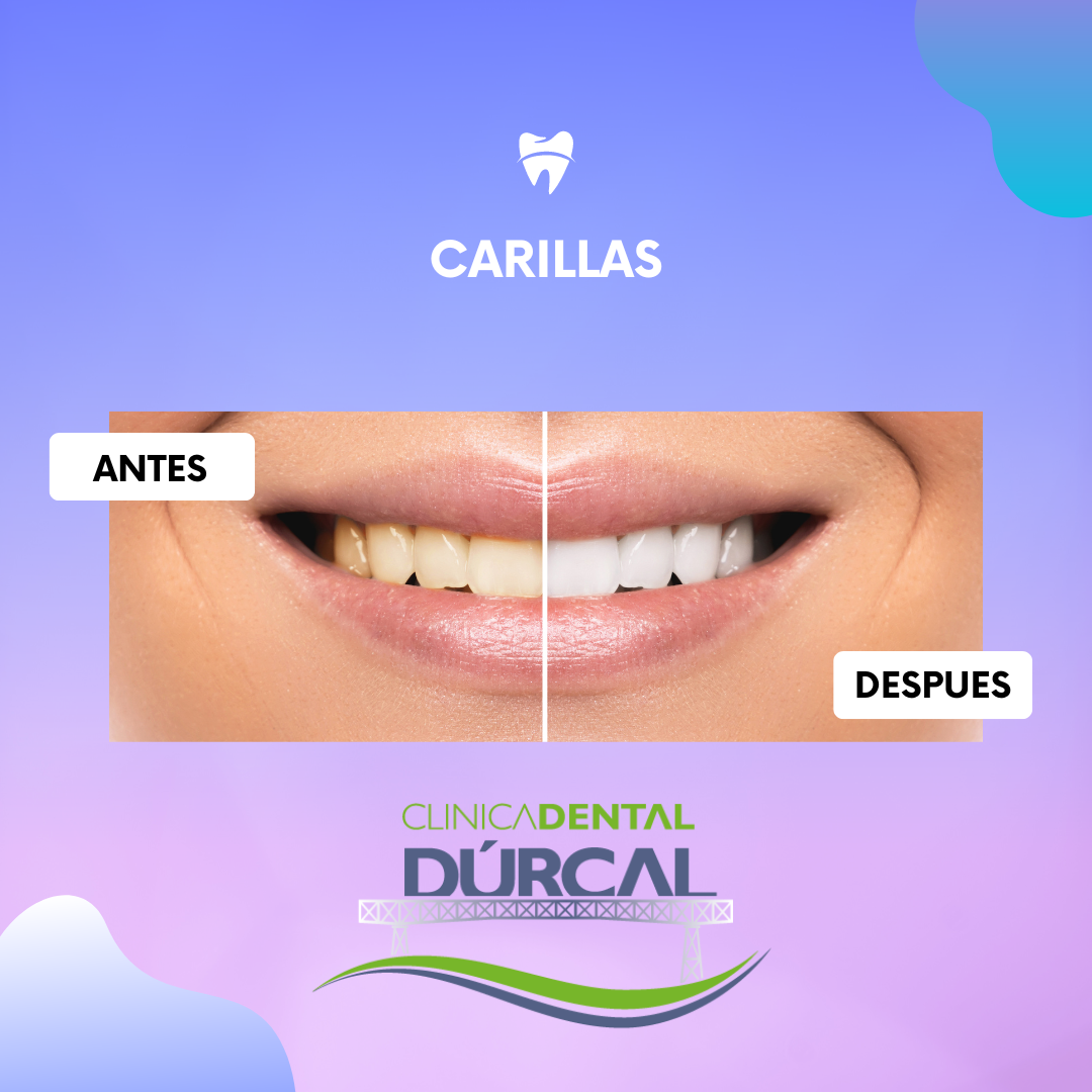 clinica dental durcal carillas